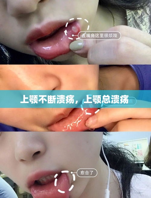 上顎不斷潰瘍，上顎總潰瘍 