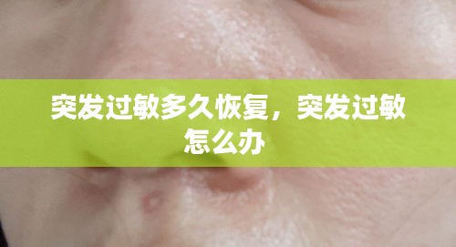 突發(fā)過敏多久恢復(fù)，突發(fā)過敏怎么辦 